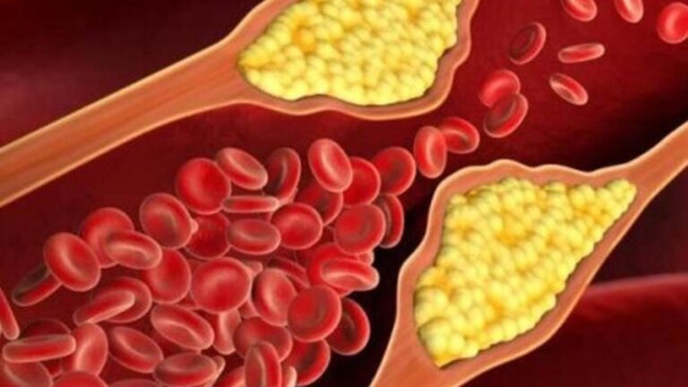 Yüksek Kolesterolü Etkili Bir Şekilde Düşürmenin Yolları