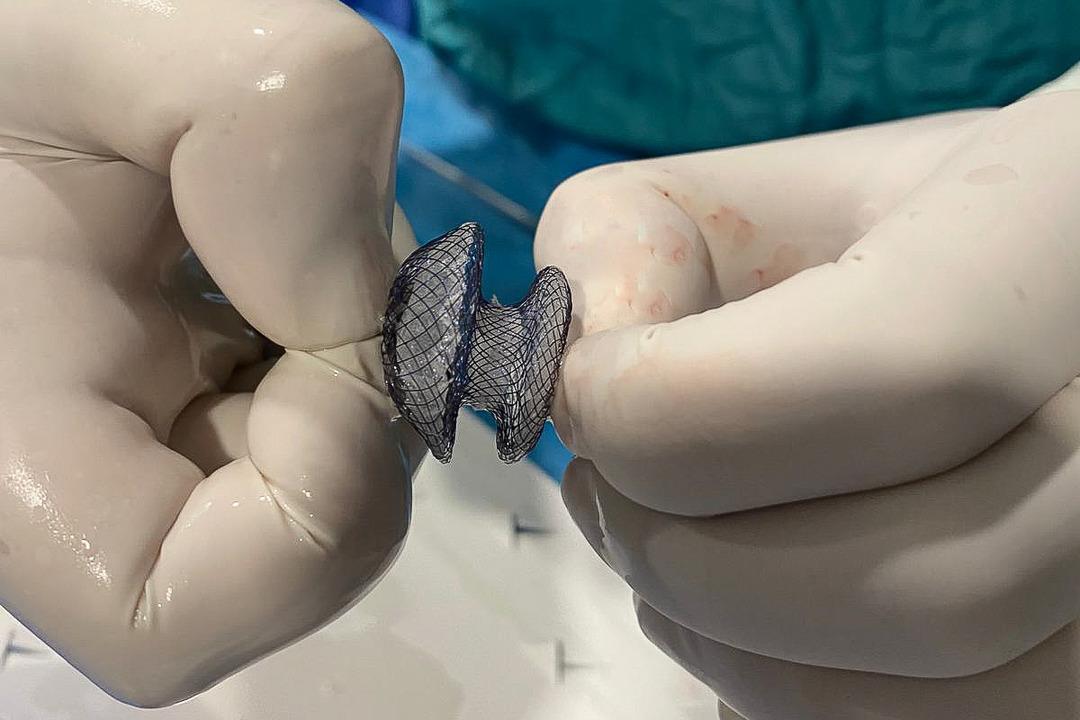 Çarpıntı, nefes darlığı ve yorgunluk şikayetiniz varsa dikkatli olun! Kalp deliği artık kapalı yöntemle tedavi edilebiliyor 2